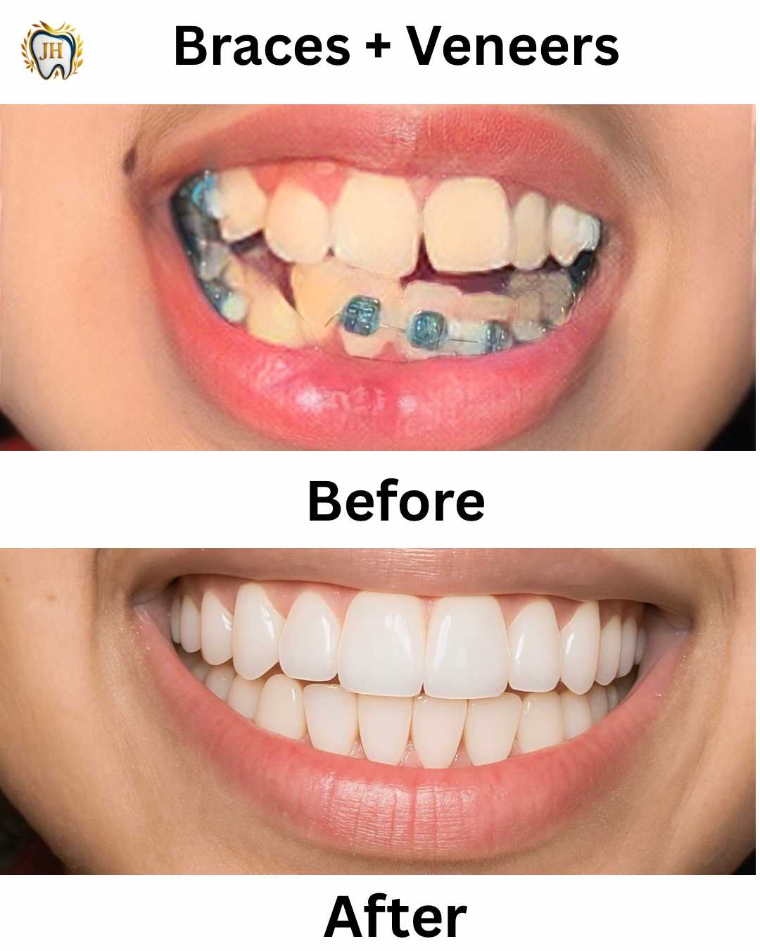 Braces + Veneers