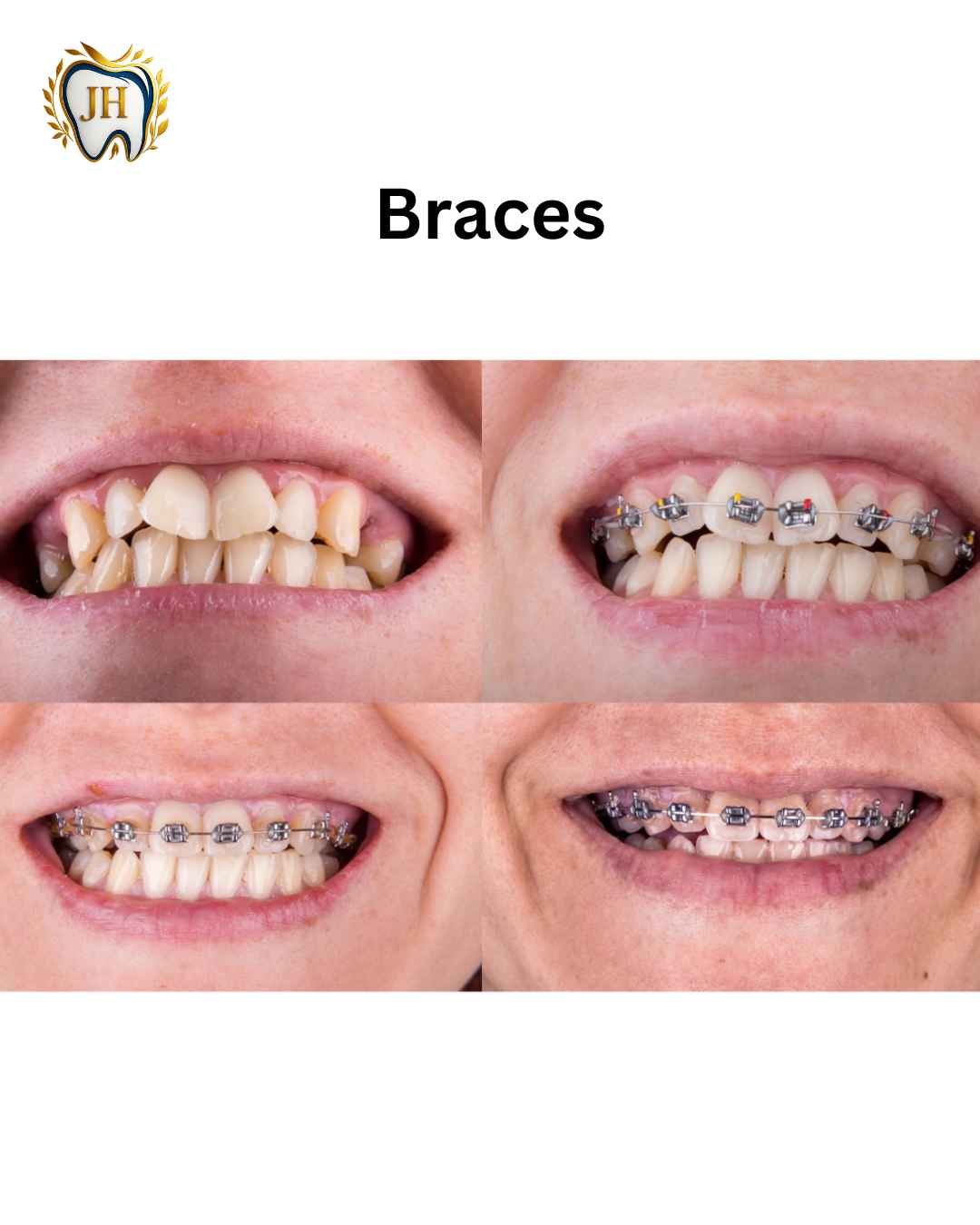 Braces