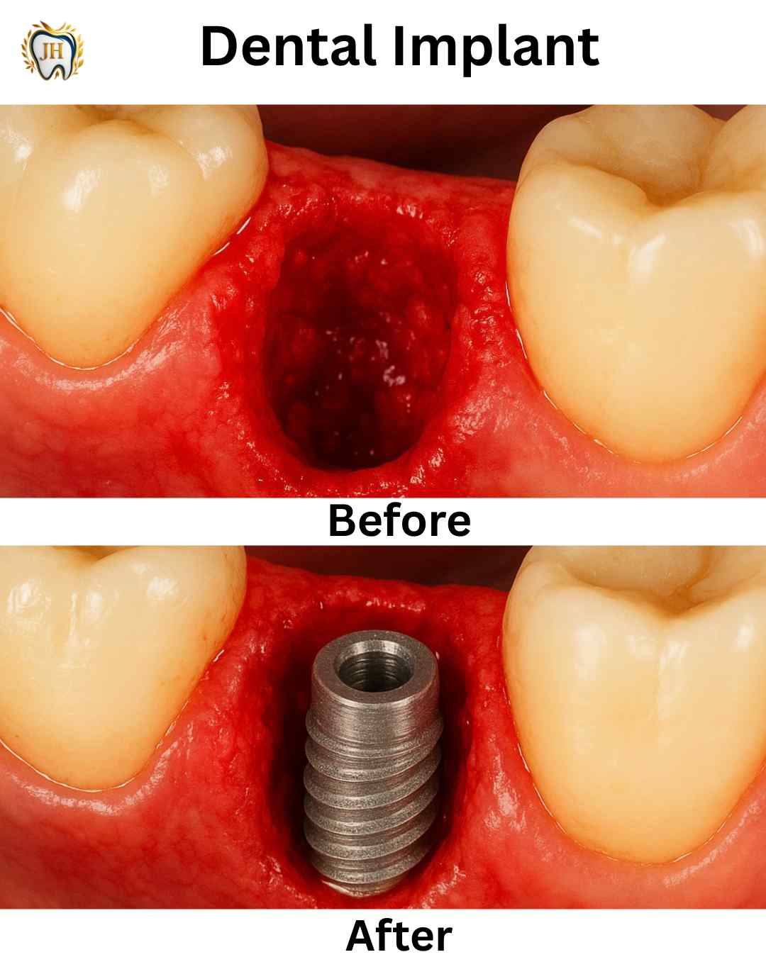 Dental Implant Before After - JH Dental Associates