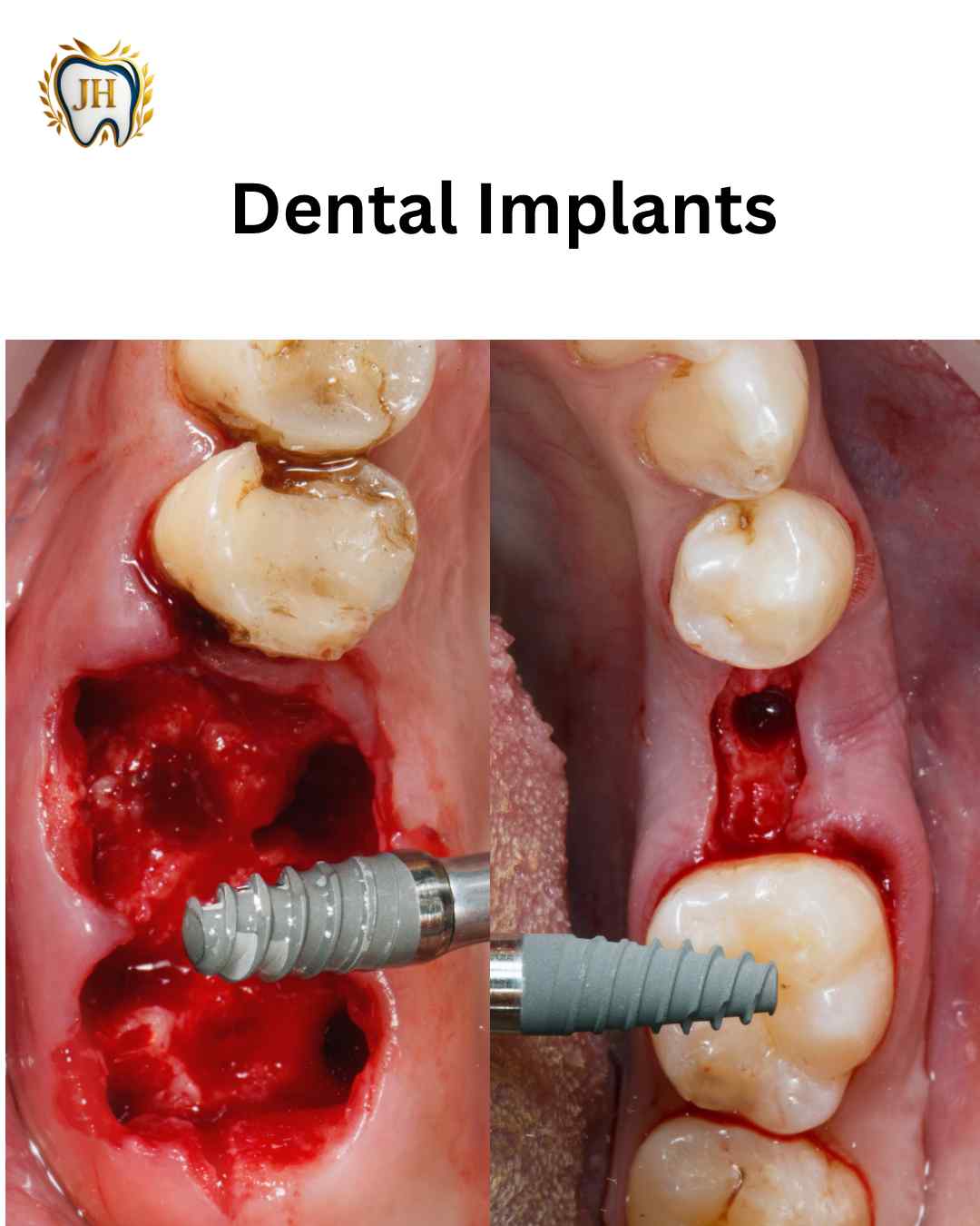 Dental Implant Before After - JH Dental Associates