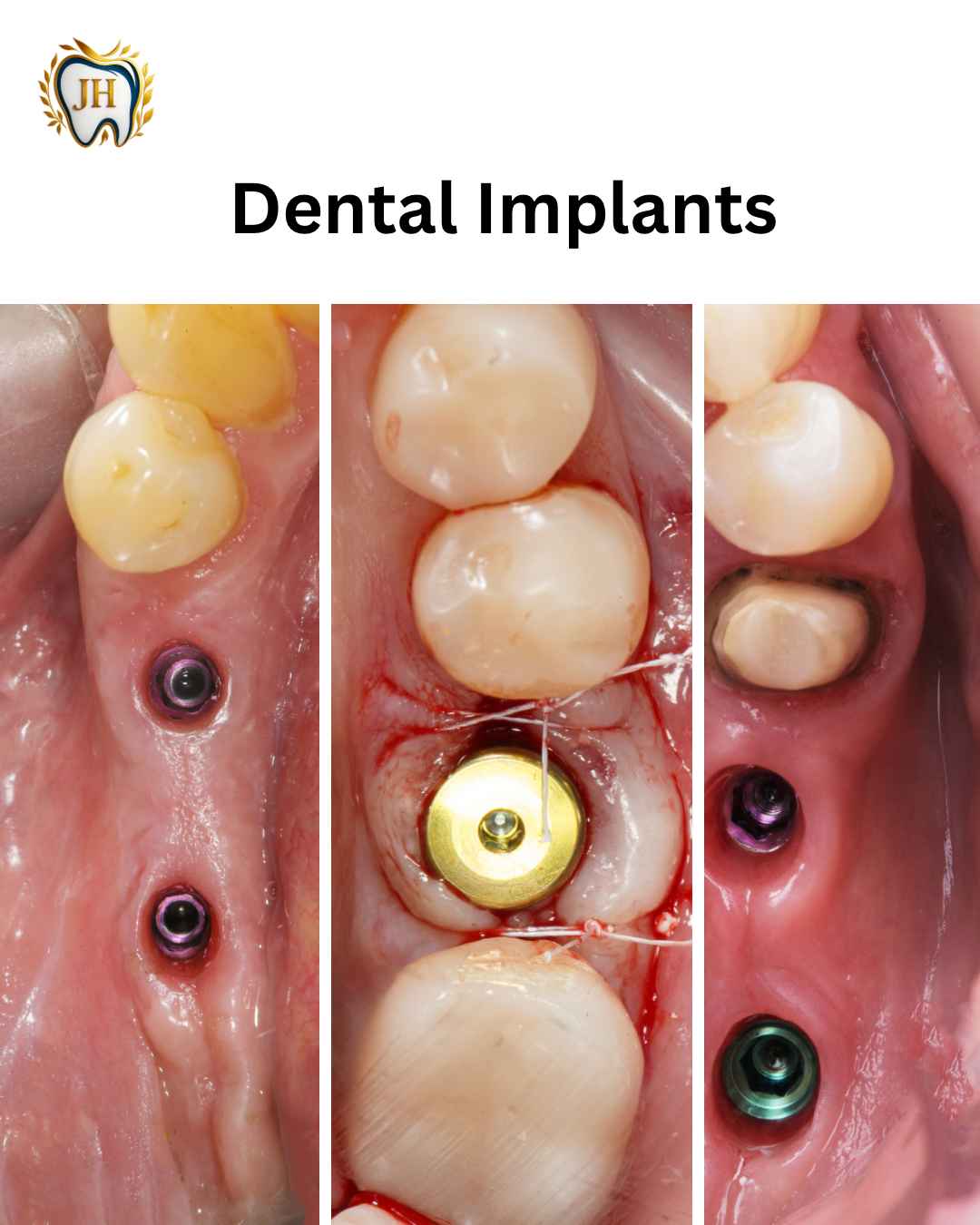 Dental Implant Before After - JH Dental Associates