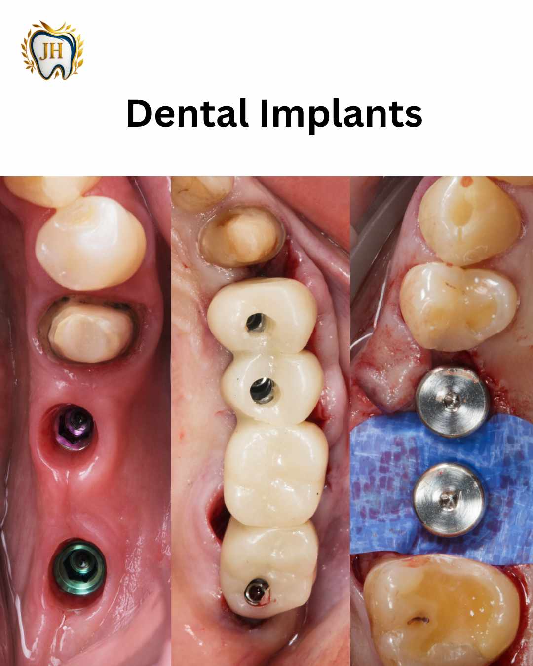 Dental Implant Before After - JH Dental Associates