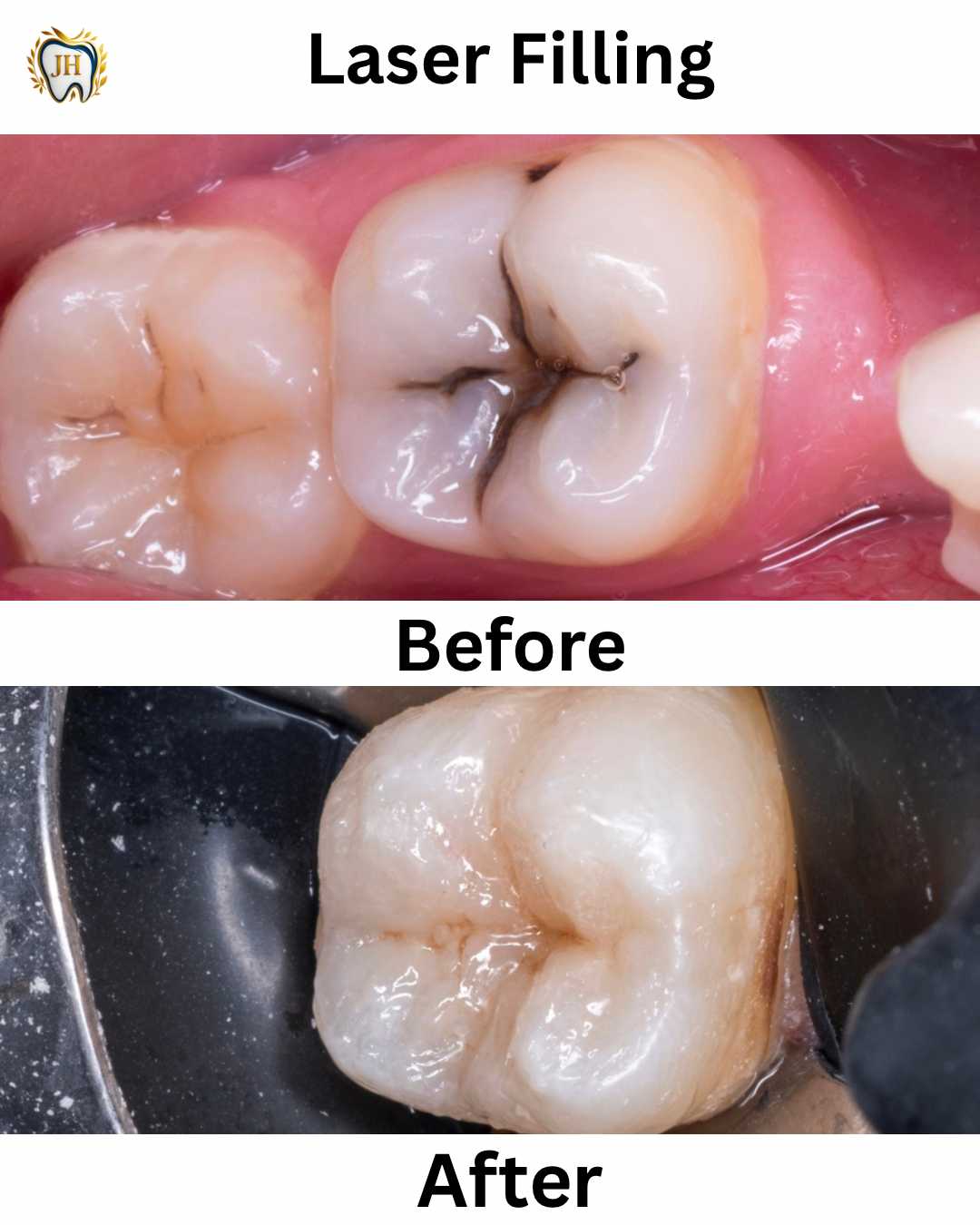 Laser Fillings 2