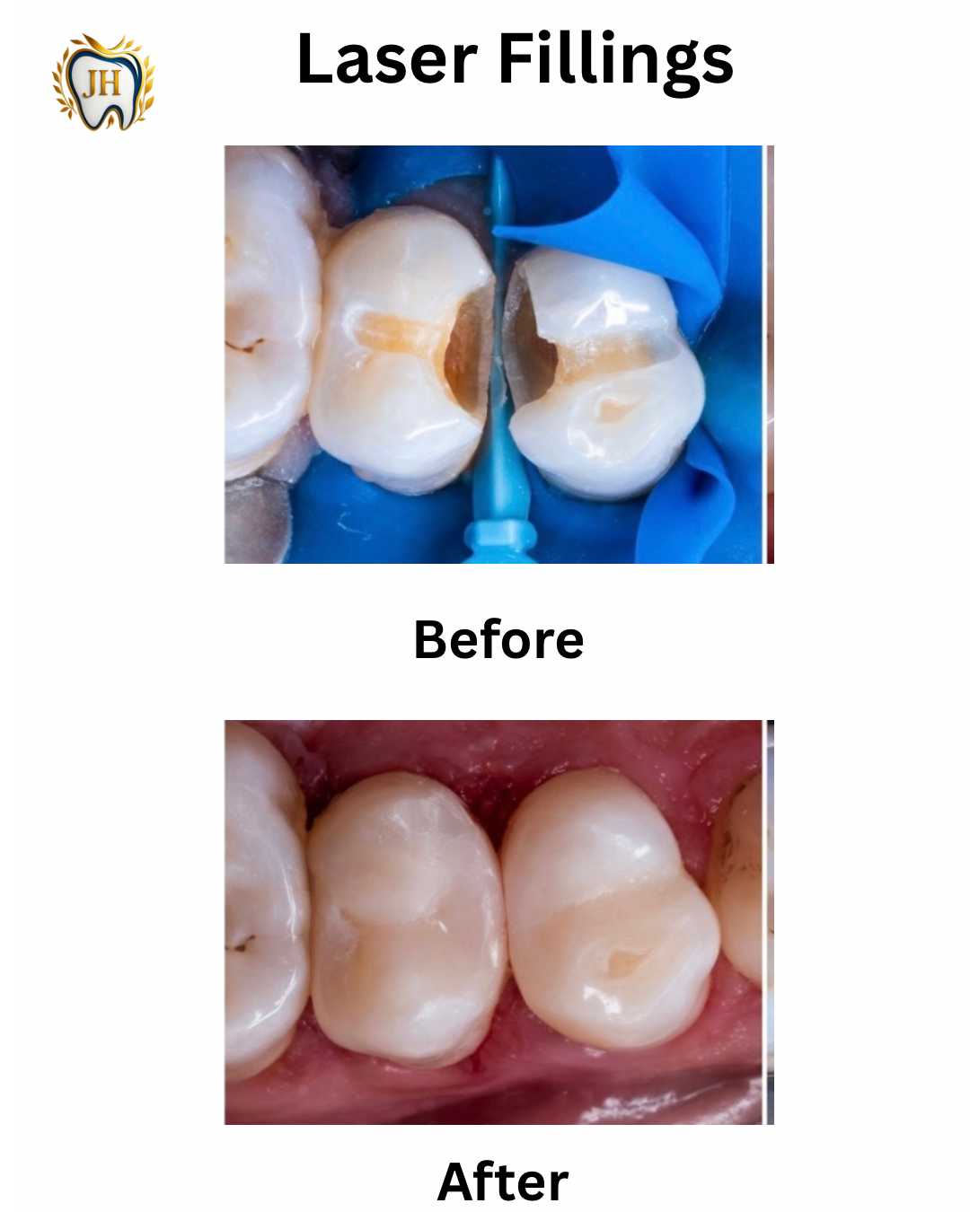 Laser Fillings