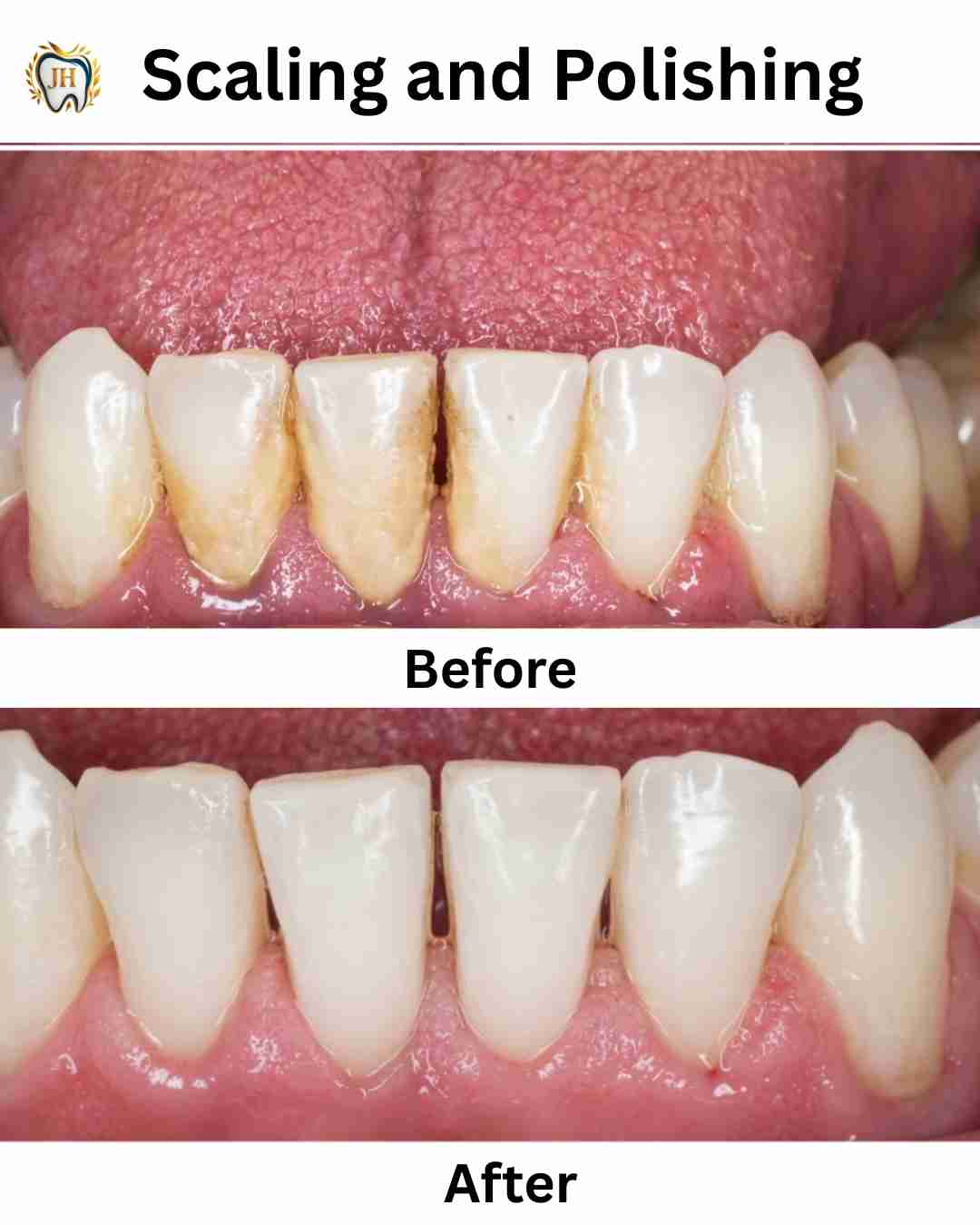 Scaling & Polishing 2