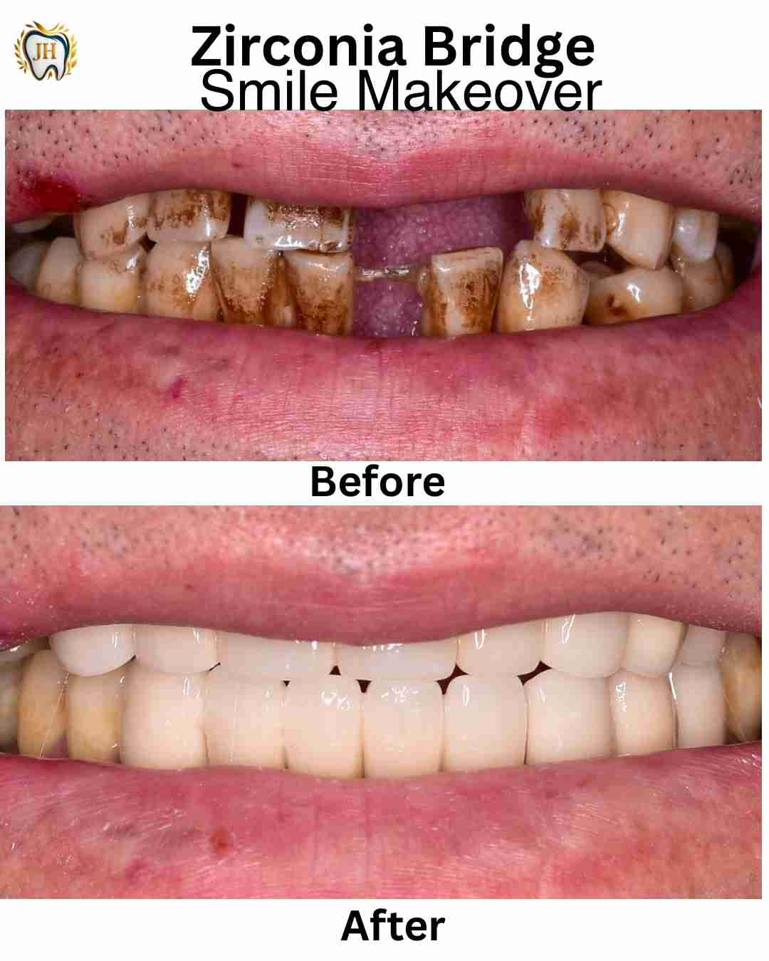 Smile makeover